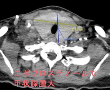 エポプロステノールで甲状腺腫大 エポプロステノールで甲状腺腫大