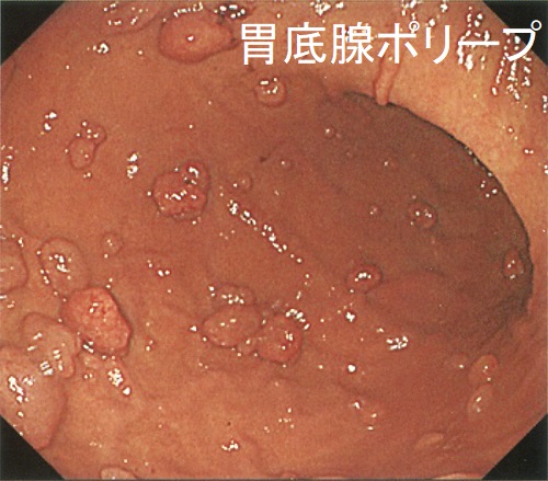 胃底腺ポリープ 胃底腺ポリープ