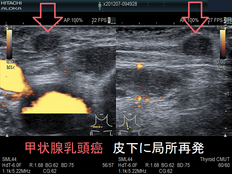甲状腺乳頭癌 皮下に局所再発 (拡大) 超音波(エコー)画像 甲状腺乳頭癌 皮下に局所再発 超音波(エコー)画像2
