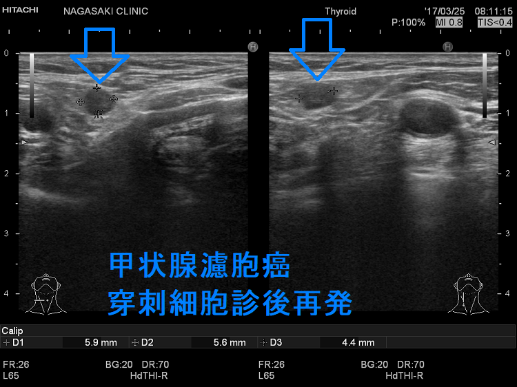 甲状腺濾胞癌 穿刺細胞診後再発 超音波(エコー)画像 甲状腺濾胞癌 穿刺細胞診後再発 超音波(エコー)画像