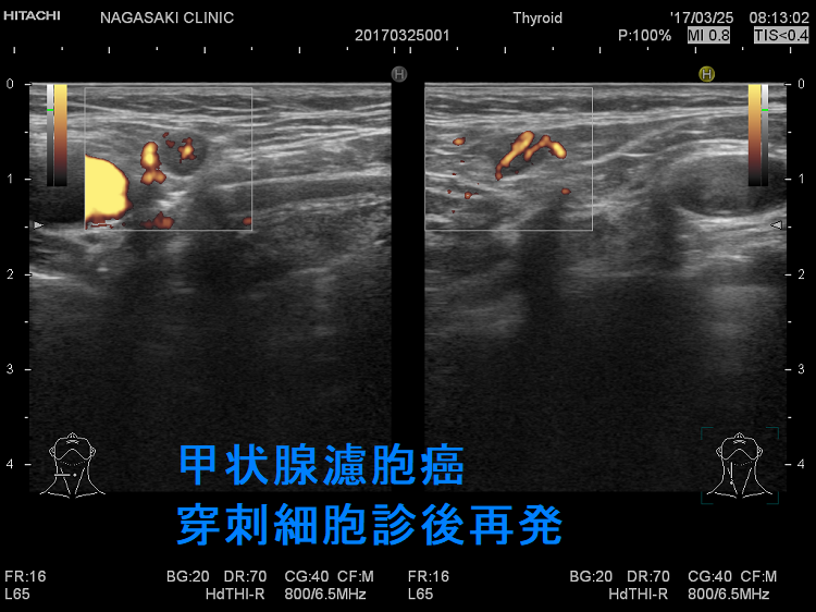 甲状腺濾胞癌 穿刺細胞診後再発 超音波(エコー)画像 ドプラーモード 甲状腺濾胞癌 穿刺細胞診後再発 超音波(エコー)画像 ドプラーモード