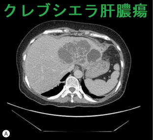 クレブシエラ肝膿瘍 造影CT画像 クレブシエラ肝膿瘍 造影CT画像