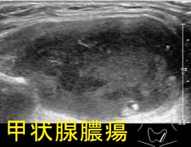 甲状腺膿瘍 甲状腺超音波(エコー)画像 甲状腺膿瘍 甲状腺超音波(エコー)画像