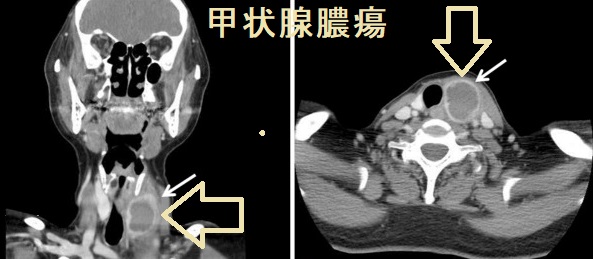 甲状腺膿瘍 甲状腺膿瘍