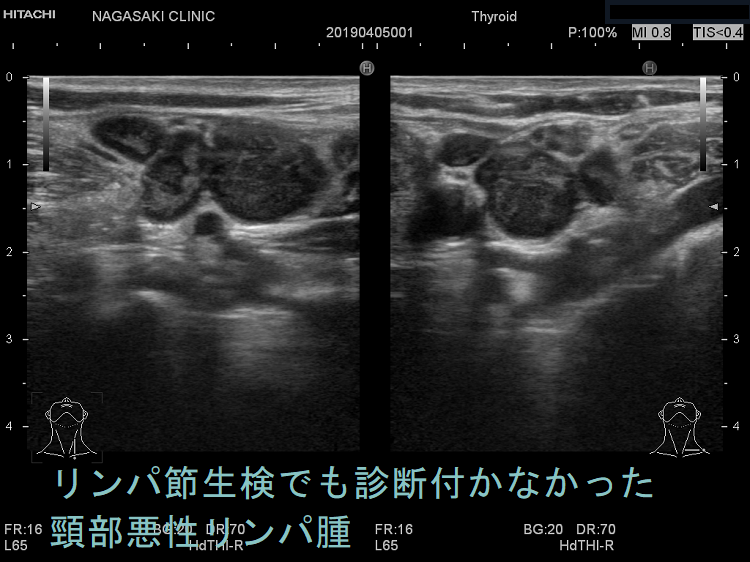 リンパ節生検でも診断付かなかった頸部悪性リンパ腫(結節性リンパ球優位B細胞リンパ腫) リンパ節生検でも診断付かなかった頸部悪性リンパ腫(結節性リンパ球優位B細胞リンパ腫)