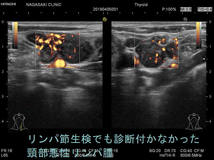 甲状腺以外の悪性リンパ腫（唾液腺MALT 血管内リンパ腫 頚部悪性