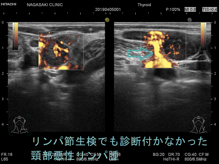 リンパ節生検でも診断付かなかった頸部悪性リンパ腫 (結節性リンパ球優位B細胞リンパ腫)ドプラーモード2 リンパ節生検でも診断付かなかった頸部悪性リンパ腫 (結節性リンパ球優位B細胞リンパ腫)ドプラーモード2