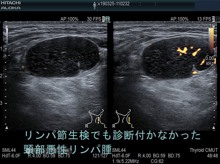 リンパ節生検でも診断付かなかった頸部悪性リンパ腫 (結節性リンパ球優位B細胞リンパ腫)2 リンパ節生検でも診断付かなかった頸部悪性リンパ腫 (結節性リンパ球優位B細胞リンパ腫)2