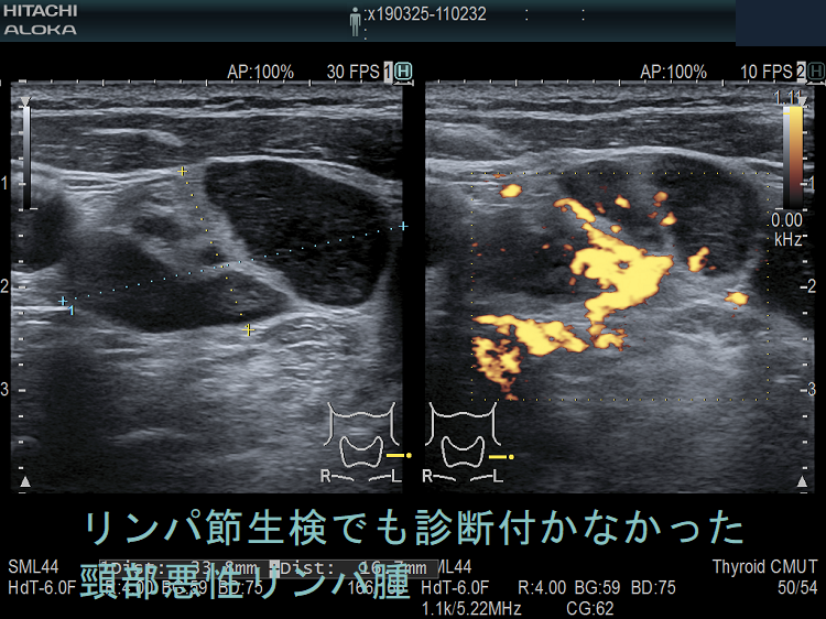 リンパ節生検でも診断付かなかった頸部悪性リンパ腫 (結節性リンパ球優位B細胞リンパ腫)4 リンパ節生検でも診断付かなかった頸部悪性リンパ腫 (結節性リンパ球優位B細胞リンパ腫)4