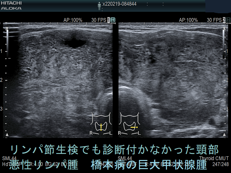 リンパ節生検でも診断付かなかった頸部悪性リンパ腫 (結節性リンパ球優位B細胞リンパ腫)橋本病の巨大甲状腺 リンパ節生検でも診断付かなかった頸部悪性リンパ腫 (結節性リンパ球優位B細胞リンパ腫)橋本病の巨大甲状腺