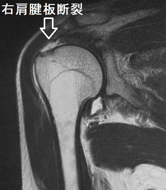 右肩腱板断裂 右肩関節MRI T2強調冠状断像 右肩腱板断裂 右肩関節MRI T2強調冠状断像