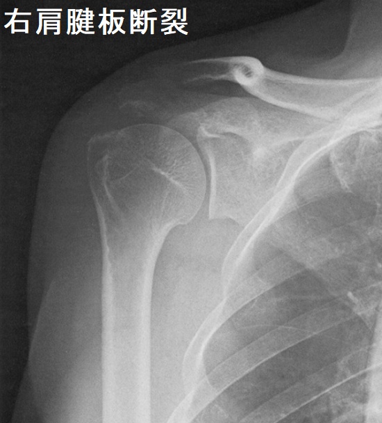右肩腱板断裂 右肩関節エックス線写真 右肩腱板断裂 右肩関節エックス線写真