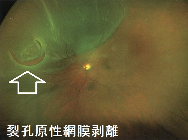 裂孔原性網膜剥離 裂孔原性網膜剥離