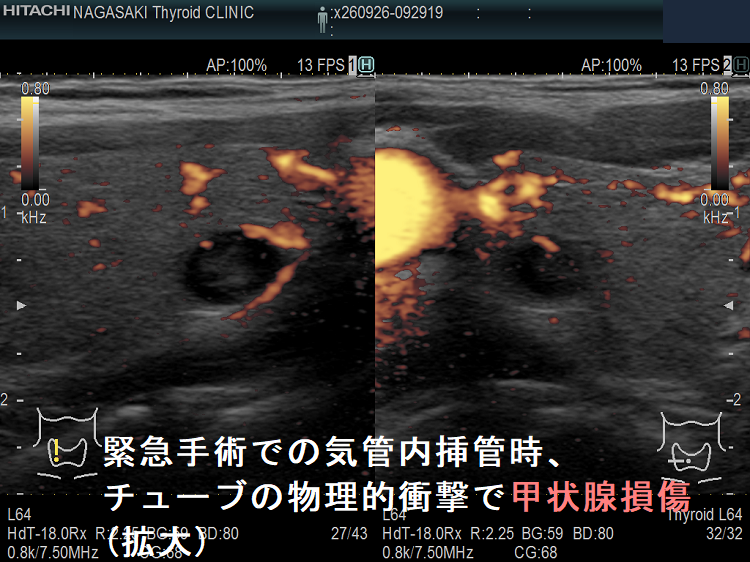 緊急手術での気管内挿管時、チューブの物理的衝撃で甲状腺損傷 ドプラーモード(拡大) 緊急手術での気管内挿管時、チューブの物理的衝撃で甲状腺損傷 ドプラーモード(拡大)