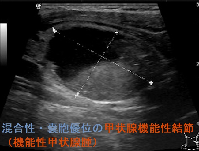 混合性・嚢胞優位の甲状腺機能性結節(機能性甲状腺腫)超音波(エコー)画像 混合性・嚢胞優位の甲状腺機能性結節(機能性甲状腺腫)超音波(エコー)画像