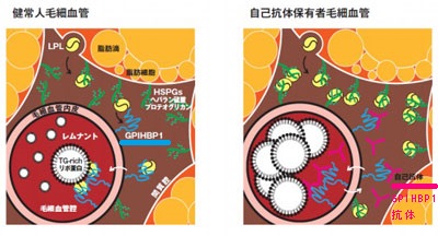 抗GPIHBP1抗体による自己免疫性の高トリグリセリド血症(高TG血症、高中性脂肪血症) 抗GPIHBP1抗体による自己免疫性の高トリグリセリド血症(高TG血症、高中性脂肪血症)