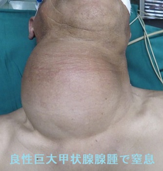良性巨大甲状腺腺腫で窒息 良性巨大甲状腺腺腫で窒息