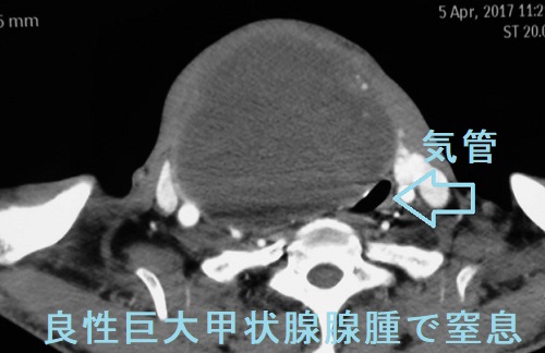良性巨大甲状腺腺腫で窒息 良性巨大甲状腺腺腫で窒息
