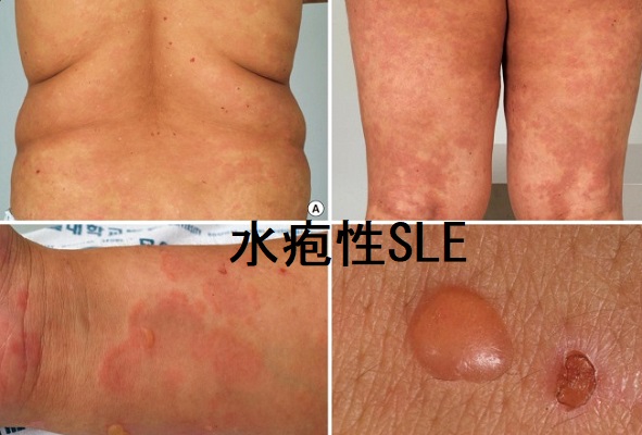 水疱性SLE 水疱性SLE