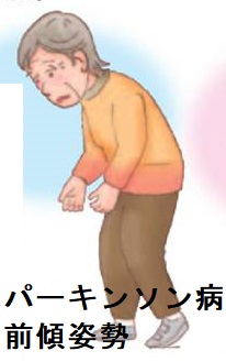 パーキンソン病 前傾姿勢 パーキンソン病 前傾姿勢