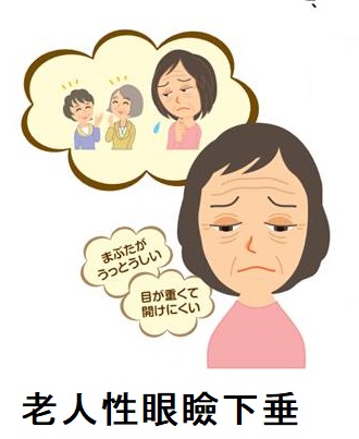 老人性眼瞼下垂 老人性眼瞼下垂