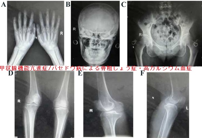 甲状腺機能亢進症/バセドウ病による骨粗しょう症・高カルシウム血症 甲状腺機能亢進症/バセドウ病による骨粗しょう症・高カルシウム血症