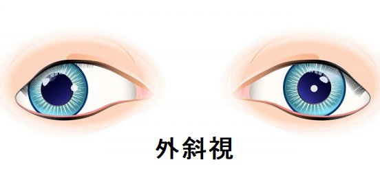 外斜視 外斜視