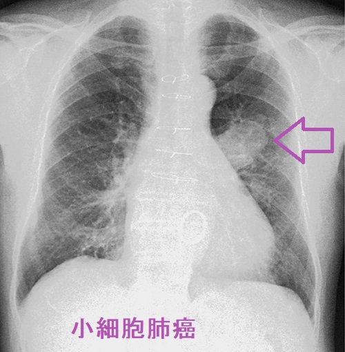 小細胞肺癌 小細胞肺癌