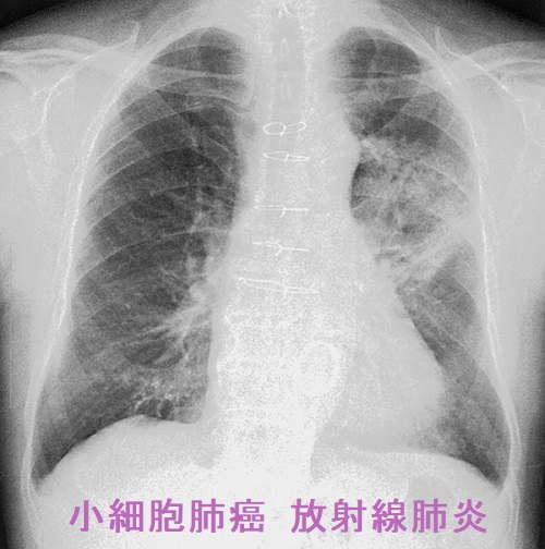 小細胞肺癌 放射線肺炎 小細胞肺癌 放射線肺炎