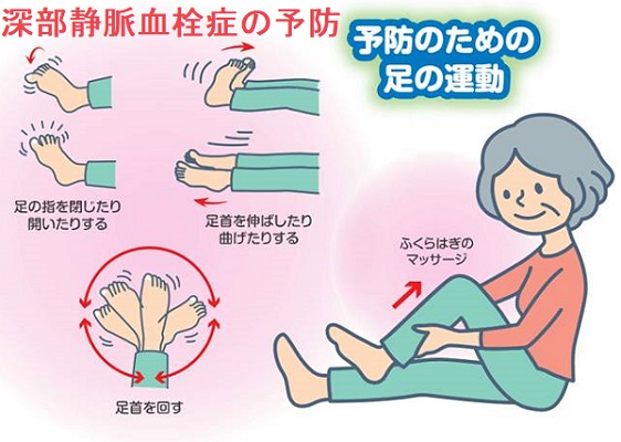 深部静脈血栓症の予防 深部静脈血栓症の予防