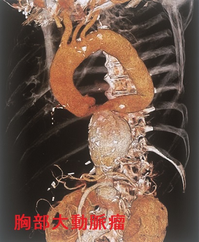胸部大動脈瘤 胸部大動脈瘤