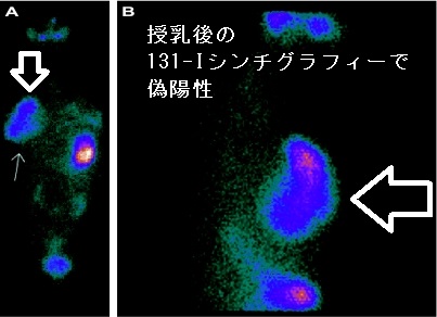 授乳後の131-Iシンチグラフィーで偽陽性 授乳後の131-Iシンチグラフィーで偽陽性