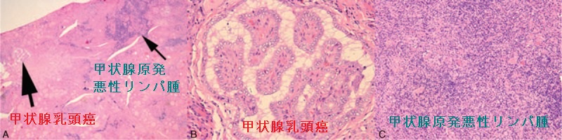 甲状腺乳頭癌と甲状腺原発悪性リンパ腫の併存 甲状腺乳頭癌と甲状腺原発悪性リンパ腫の併存