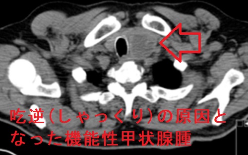 吃逆(しゃっくり)の原因となった機能性甲状腺腫 吃逆(しゃっくり)の原因となった機能性甲状腺腫