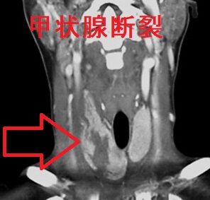 甲状腺断裂 造影CT画像 甲状腺断裂 造影CT画像