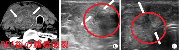 ラジオ波焼灼療法(RFA)後の腫瘍破裂 ラジオ波焼灼療法(RFA)後の腫瘍破裂