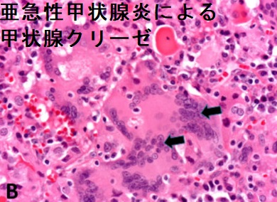 亜急性甲状腺炎による甲状腺クリーゼ 組織像 亜急性甲状腺炎による甲状腺クリーゼ 組織像