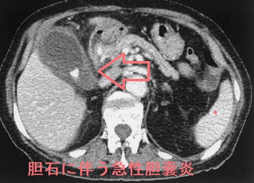 胆石による急性胆嚢炎 胆石による急性胆嚢炎