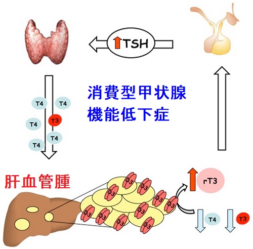 消費型甲状腺機能低下症 消費型甲状腺機能低下症