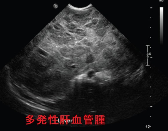 多発性肝血管腫 多発性肝血管腫
