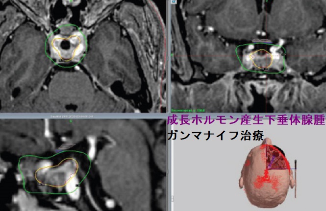 成長ホルモン産生下垂体腺腫 ガンマナイフ治療 成長ホルモン産生下垂体腺腫 ガンマナイフ治療