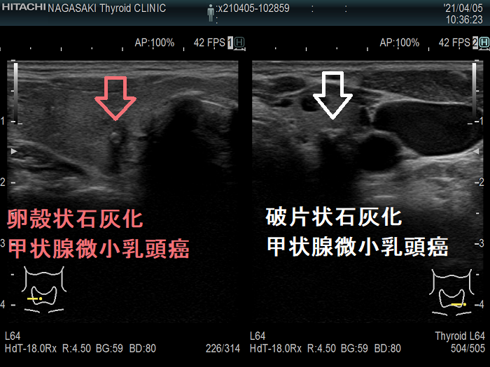 卵殻状石灰化と破片状石灰化の甲状腺微小乳頭癌 卵殻状石灰化と破片状石灰化の甲状腺微小乳頭癌