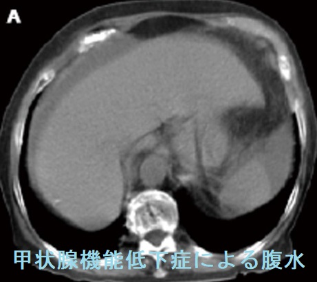 甲状腺機能低下症による腹水 甲状腺機能低下症による腹水