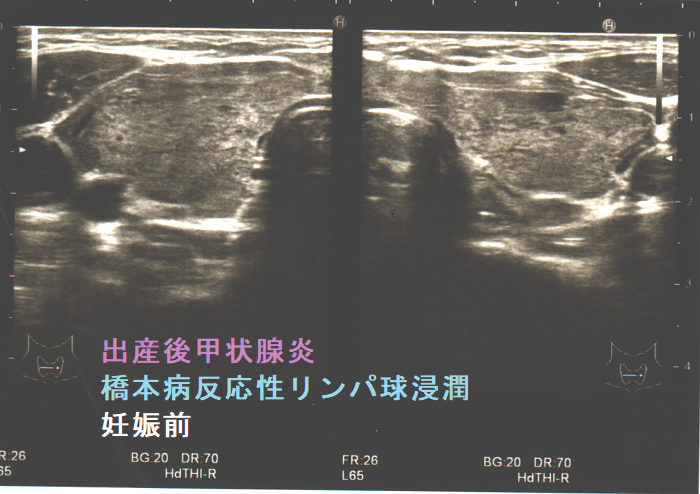 出産後甲状腺炎 橋本病反応性リンパ球浸潤 妊娠前 出産後甲状腺炎 橋本病反応性リンパ球浸潤 妊娠前