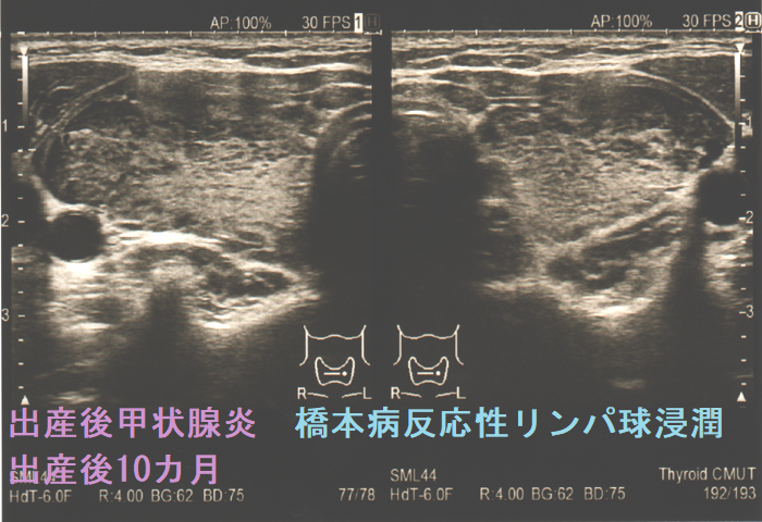 出産後甲状腺炎の橋本病反応性リンパ球浸潤 出産後10カ月 出産後甲状腺炎の橋本病反応性リンパ球浸潤 出産後10カ月