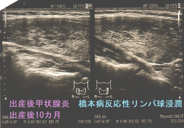 出産後甲状腺炎の橋本病反応性リンパ球浸潤 出産後10カ月 出産後甲状腺炎の橋本病反応性リンパ球浸潤 出産後10カ月