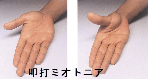 筋強直性ジストロフィー 叩打ミオトニア 筋強直性ジストロフィー 叩打ミオトニア