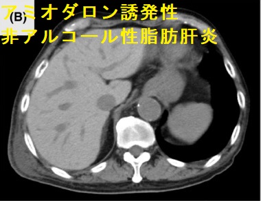 アミオダロン誘発性非アルコール性脂肪肝炎 アミオダロン誘発性非アルコール性脂肪肝炎