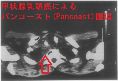 甲状腺乳頭癌によるパンコースト腫瘍 CT画像 甲状腺乳頭癌によるパンコースト腫瘍 CT画像