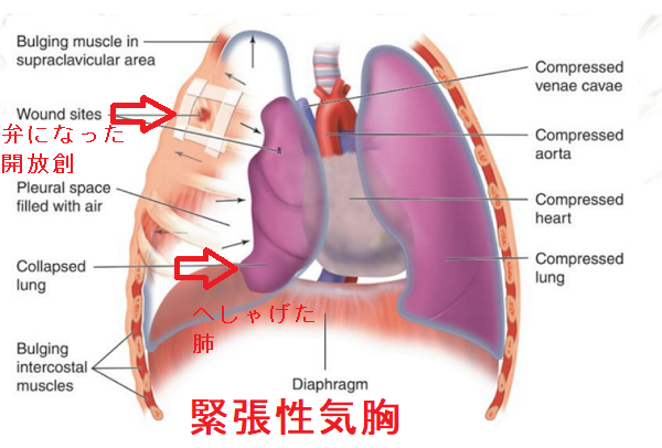 緊張性気胸 緊張性気胸